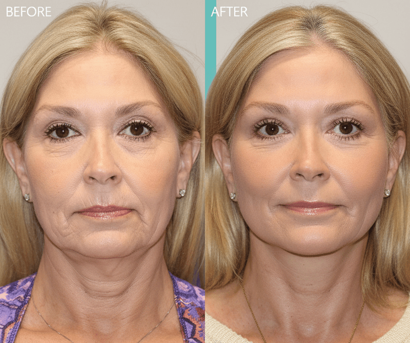 Maria, 44. Firmer Jawline in 4 Weeks